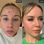 ترانگزامیک اسید اینکی لیست - تصویر 3