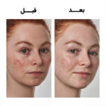 The-INKEY-List-SuperSolutions-Azelaic-Acid-10%-Serum-سرم آزلائیک اسید ۱۰% سوپرسولوشن اینکی لیست